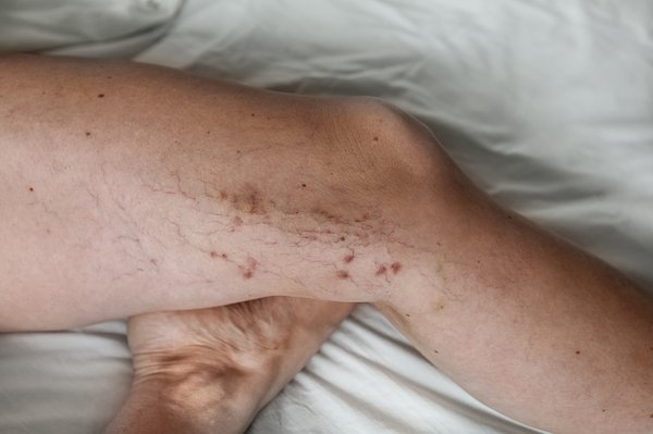 Intervention au laser endoveineux : votre solution rapide et efficace